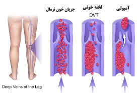 آمبولی ریوی و ترومبو آمبولی وریدی